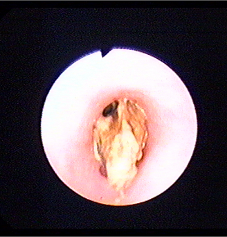 Инородное тело пищевода (кусок мяса). Атлас эндоскопических изображений endoatlas